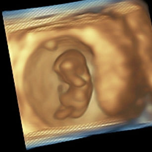 10 weeks pregnant 3d ultrasound picture of baby's body