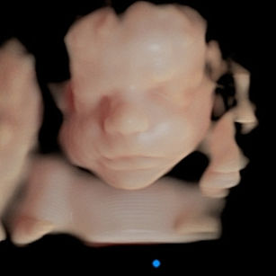 3D ultrasound picture at 26 weeks 5 days pregnant of baby's face in virtual HD
