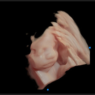 3D ultrasound picture at 29 weeks 4 days pregnant of baby's face in virtual HD