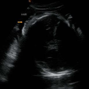 38 weeks pregnant 2D ultrasound picture of baby hair