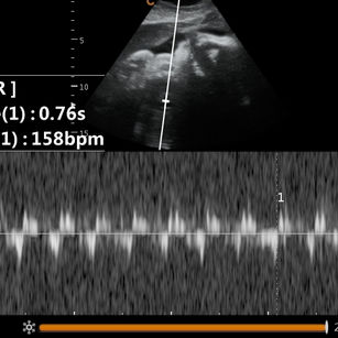 2D ultrasound picture at 36 weeks 2 days pregnant of baby's heart rate