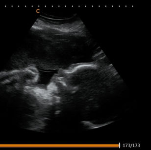2D ultrasound picture at 31 weeks pregnant of baby's profile and anterior placenta