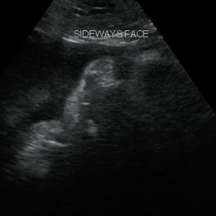 2D ultrasound picture at 36 weeks 2 days pregnant of baby's face