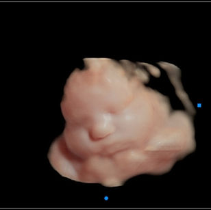 35 weeks 2 days pregnant 3D Ultrasound Picture of baby's face in virtual HD