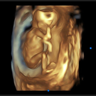 3D Ultrasound picture at 16 weeks 5 days pregnant of baby's body