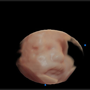 3D ultrasound picture at 32 Weeks 6 Days pregnant of baby's face in virtual HD