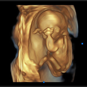 3D Ultrasound picture at 16 weeks 5 days pregnant of baby's arms near the head