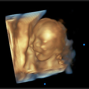 3D-ultrasound-picture-18-weeks-4-days-pregnant-baby-face