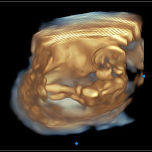 3D ultrasound picture at 16 weeks 6 days pregnant of baby's body