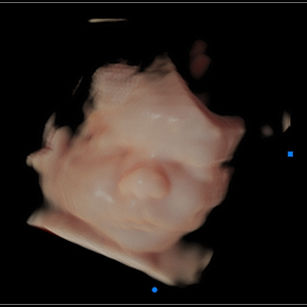 3D ultrasound picture at 31 weeks 1 day pregnant of baby's face in virtual hd