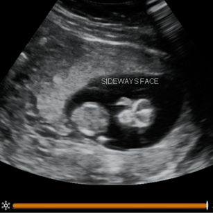 2D ultrasound picture at 11 weeks pregnant of baby's face