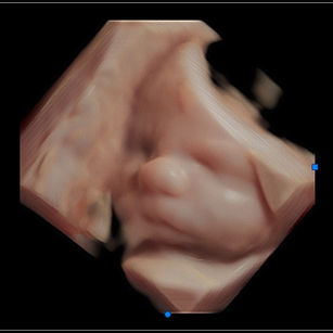 3D ultrasound picture at 31 weeks 1 day pregnant of baby's face in virtual hd