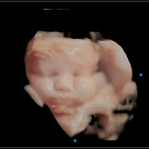 35 weeks 1 day pregnant 3D Ultrasound Picture of baby's face in virtual HD