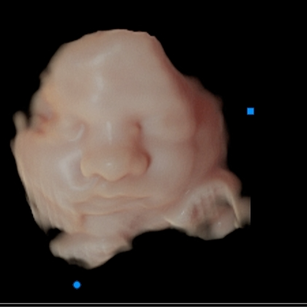 31 weeks 5 days pregnant 3d ultrasound picture of baby's face in virtual hd