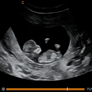 2D Ultrasound Picture at 11 Weeks 4 Day Pregnant of Baby's profile