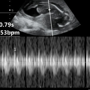 15 weeks 5 days pregnant 2D ultrasound picture of baby's heart rate