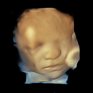 32 weeks 3 days pregnant 3D ultrasound picture of baby's face
