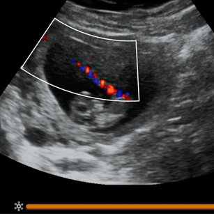 10 weeks pregnant 2d ultrasound picture of baby's umbilical cord blood flow