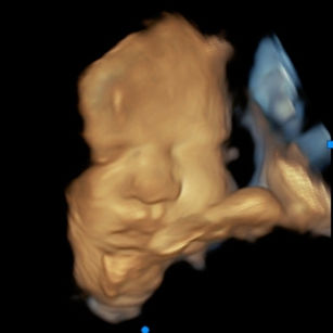 3D ultrasound picture at 35 weeks 4 days pregnant of baby's face