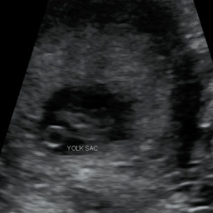 2D ultrasound picture at 8 weeks 5 days pregnant of baby's yolk sac