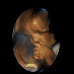 3D ultrasound picture at 33 weeks 6 days pregnant of baby's face