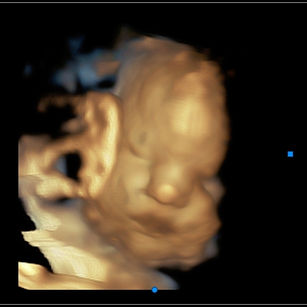 3D ultrasound picture at 38 weeks 2 days pregnant of baby's face