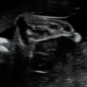 2D ultrasound picture at 31 weeks 3 days pregnant of baby's foot