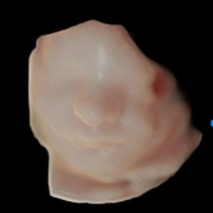 3D ultrasound picture at 31 weeks 6 days pregnant of baby's face in virtual HD