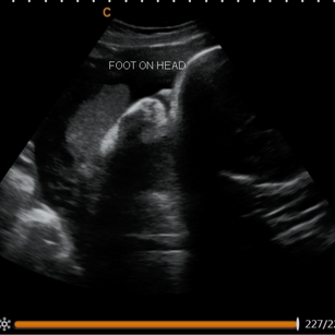 35 weeks 3 days pregnant 2D Ultrasound Picture of baby's foot on the head