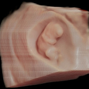 3D ultrasound picture of baby at 9 weeks 6 days pregnant in virtual hd
