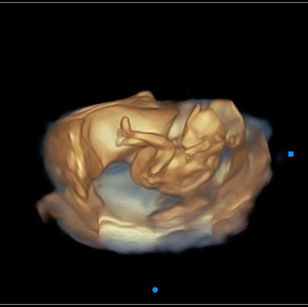 3D-ultrasound-picture-18-weeks-2-days-pregnant-baby-body