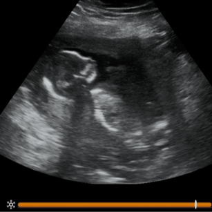 2D Ultrasound picture at 16 weeks pregnant of baby's profile