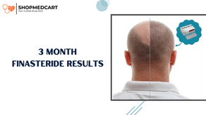 3 Month Finasteride Results