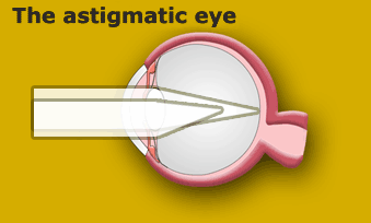 Astigmatism