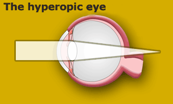 Hyperopia