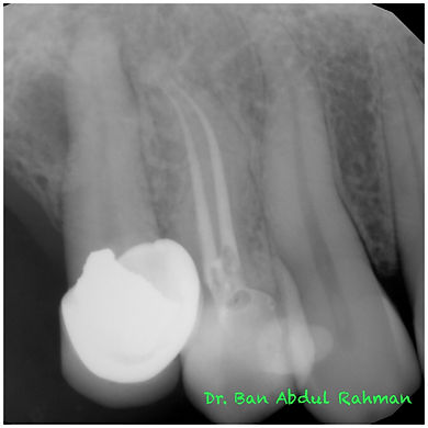 Orthordontics Before & After - Treatment Gallery - Moonstone Dental