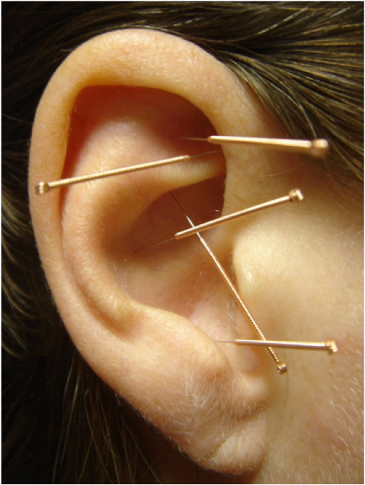 Auriculoterapia