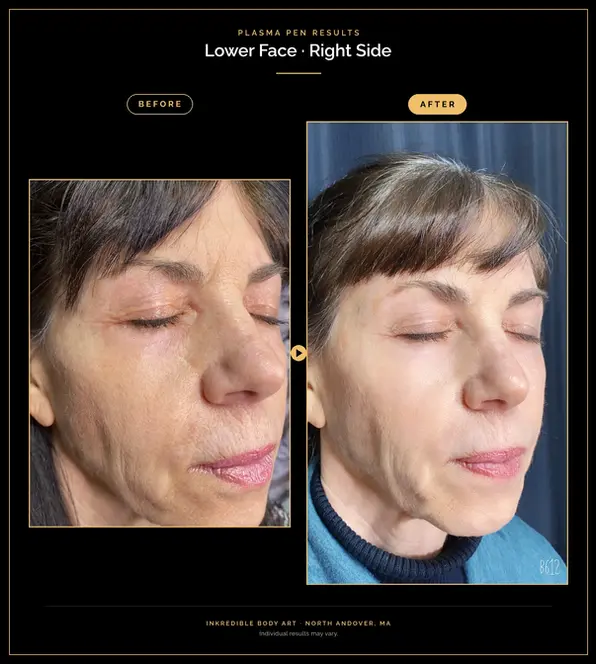 Plasma pen before and after – right side of lower face with softer smile lines and firmer skin, North Andover, MA
