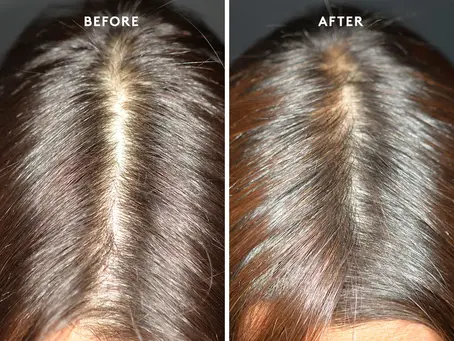 Freaking Out About Hair Loss? Here’s the Real Solution That Works