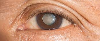 Opacità del cristallino