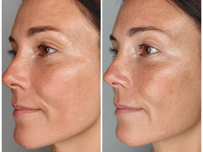 The Science of Tight Skin (Stretta HIFU)