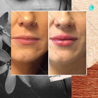 Lip Fillers