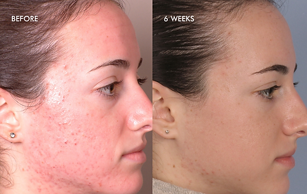 Dermal Infusion Facial