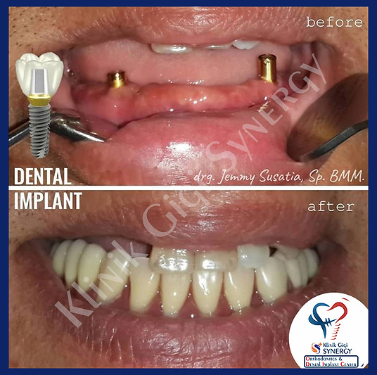 implant supported denture.jpg