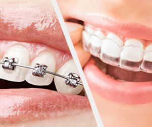 braces aligner home.jpg