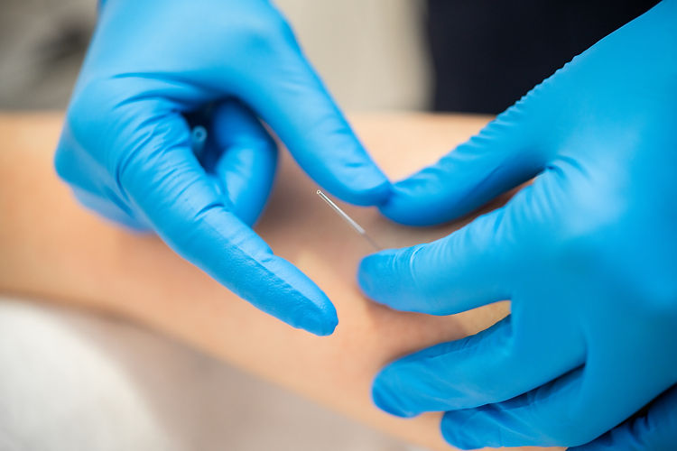 Close-up of a needle and hands of physiotherapist doing a dry needling in a physiotherapy
