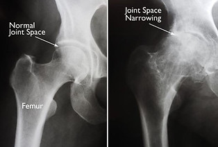 Normal vs Arthritic Hip