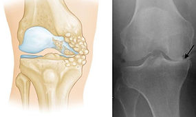 Severe Osteoarthritis