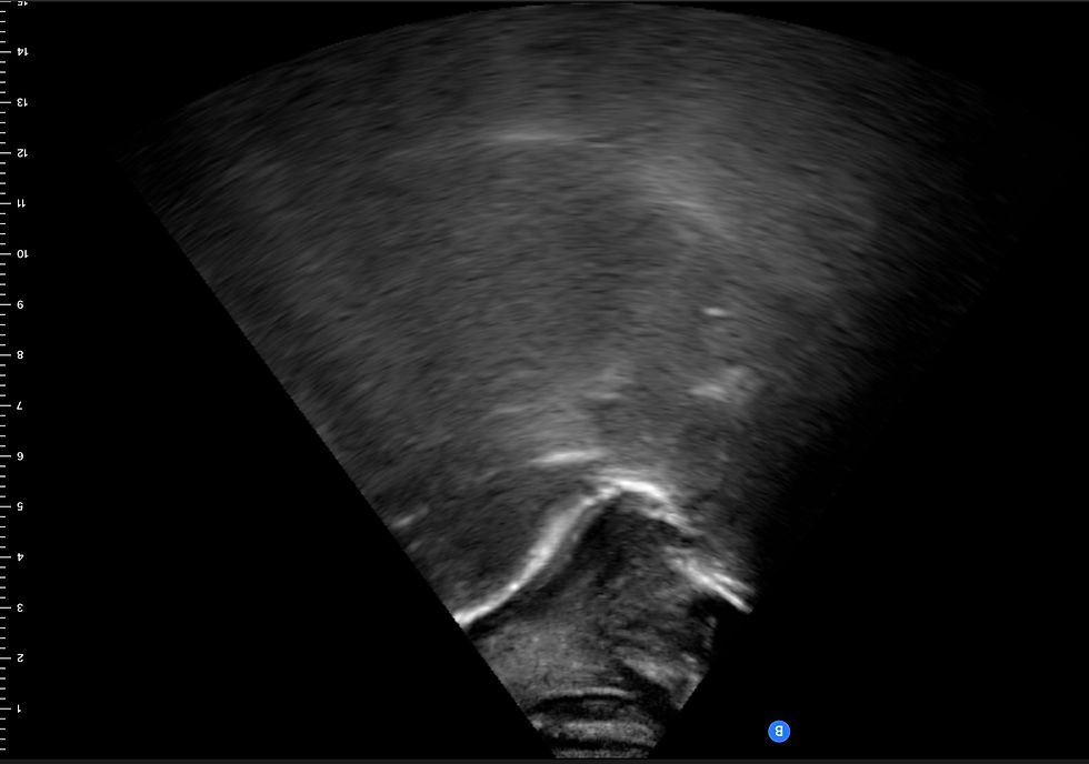 Ultrasound Speech Therapy for R Sound | Connect Therapy
