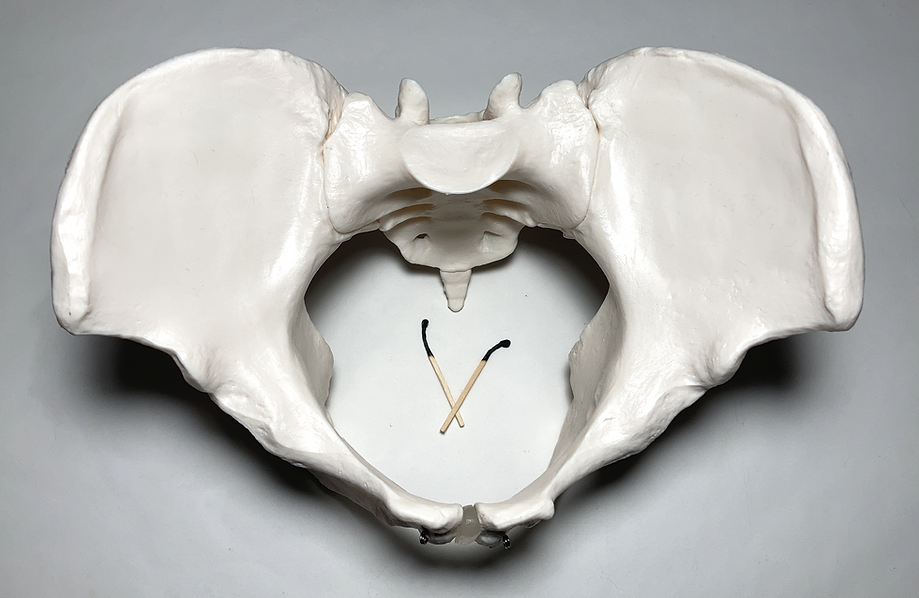 two burnt matchsticks sit in the center of a 3D model of a pelvis